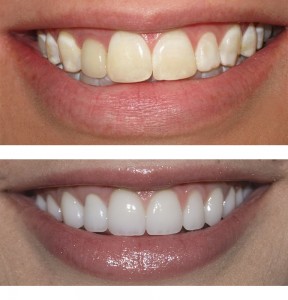 whitener teeth 