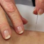  acupuncture practitioner