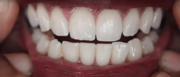 perfect dental implants