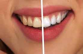 teeth whitening before and after