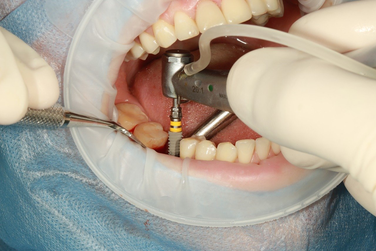 implant surgery dentist